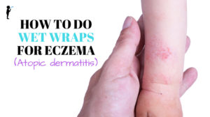 How to do wet wraps for eczema. #Naturopathic #Pediatrics