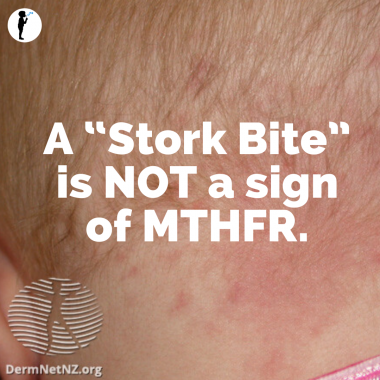 A “Stork Bite” is NOT a sign of MTHFR - Naturopathic Pediatrics